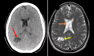 Man, 52, who suffered constant migraines is found to have a live WORM in his brain that had laid eggs under his skull - after catching parasite from undercooked bacon